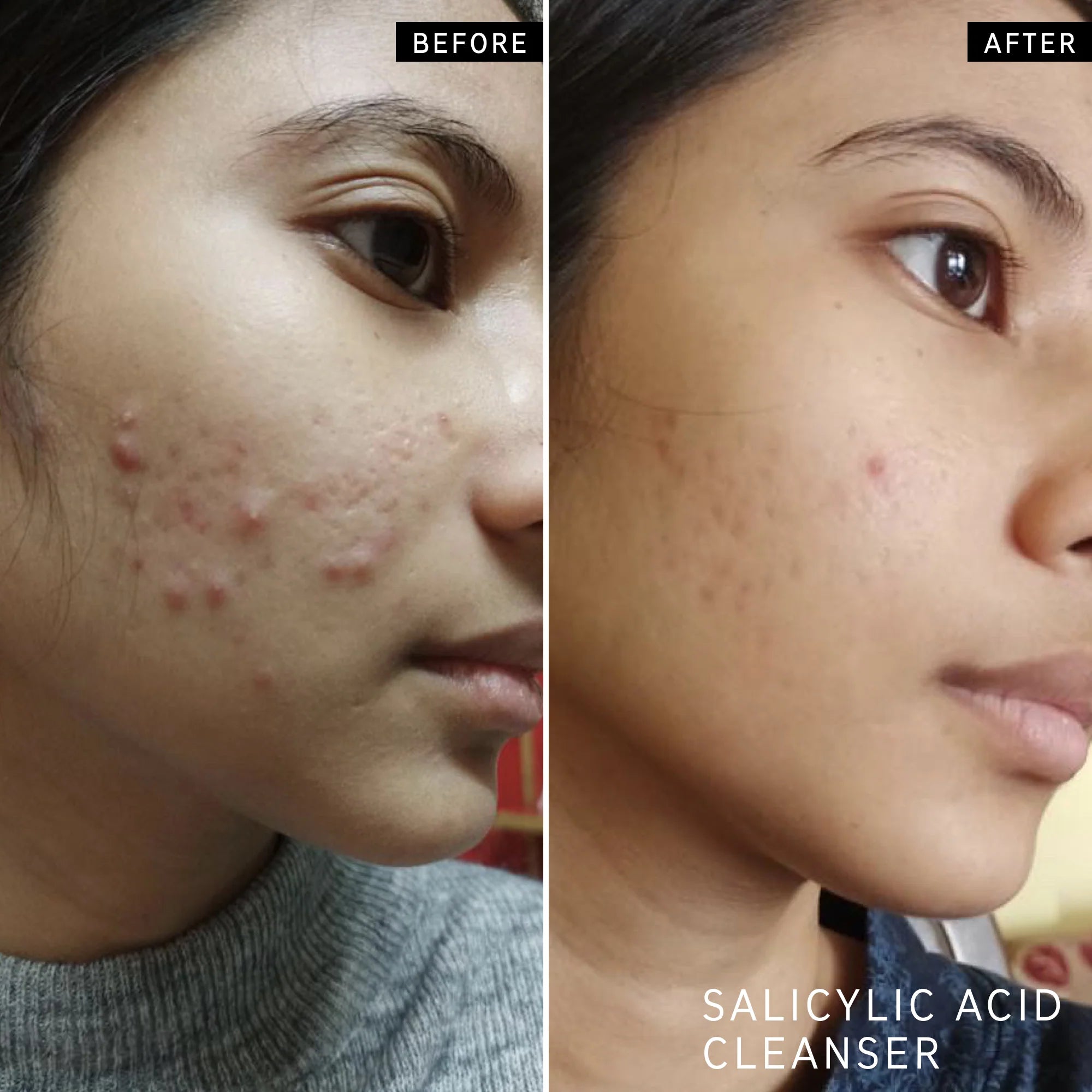 BEfore and after using The Inkey List The Spot On Duo - Model