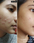 BEfore and after using The Inkey List The Spot On Duo - Model