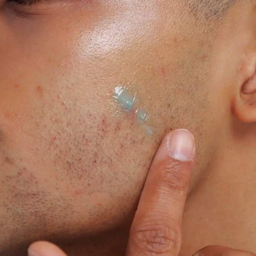 Model using The Inkey List 2% Succinct Acid Blemish Treatment