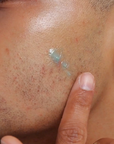 Model using The Inkey List 2% Succinct Acid Blemish Treatment