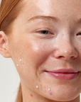 Model using The Inkey List 2% Succinct Acid Blemish Treatment