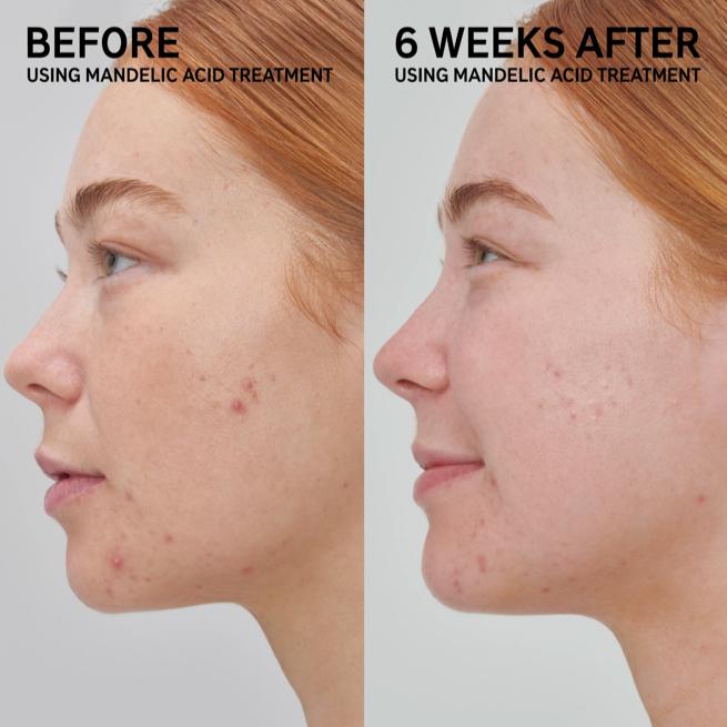 Before and after The Inkey List MANDELIC ACID TREATMENT