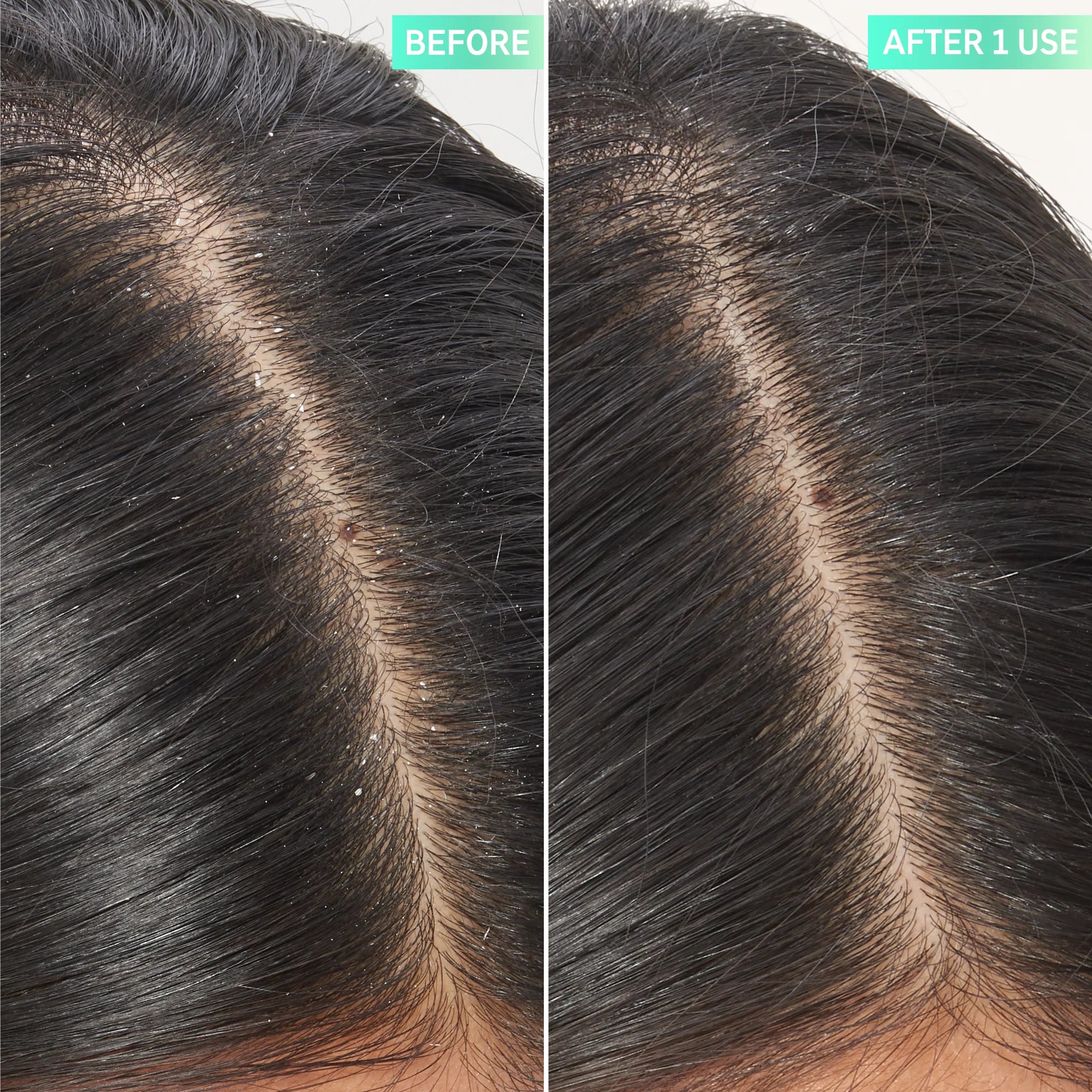 Before and after using The Inkey List Salicylic Acid Exfoliating Scalp Treatment 150ml