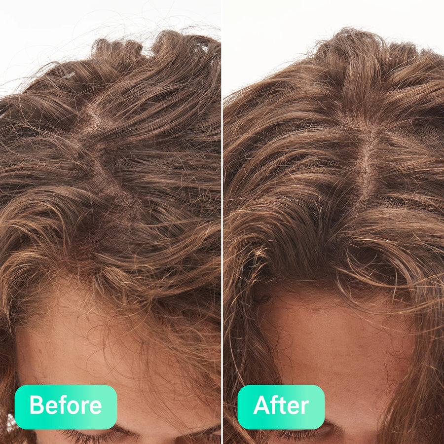 Before and after The Inkey List Gylcolic Scalp Treatment 