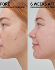 Before and after The Inkey List MANDELIC ACID TREATMENT